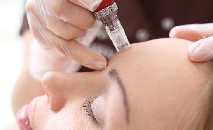 Best Microneedling in Northern Virginia