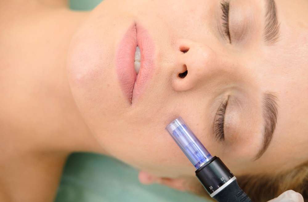 What Is Microneedling?