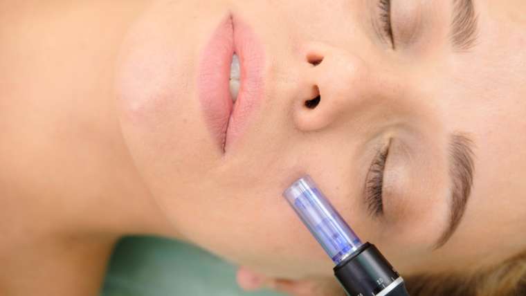 What Is Microneedling?