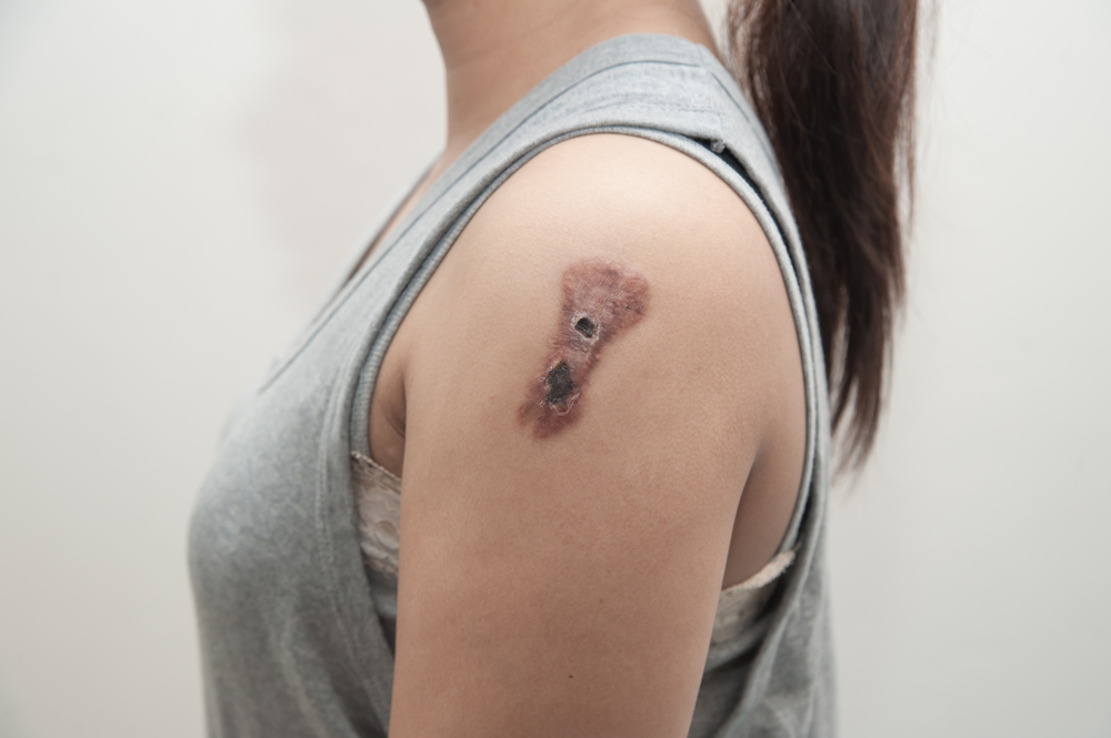 Top 3 Skin Cancers Northern Virginia