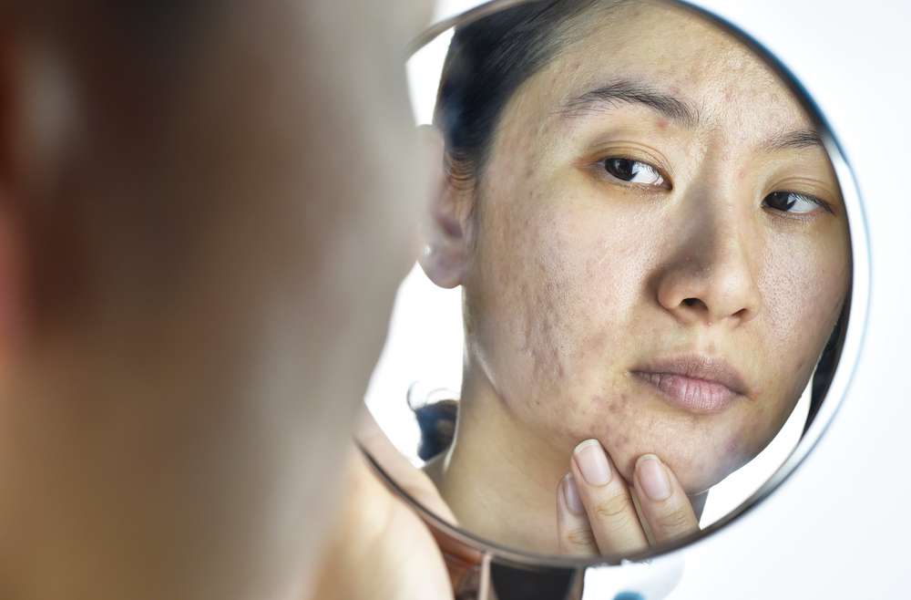 What Can I Do About Acne Scars?