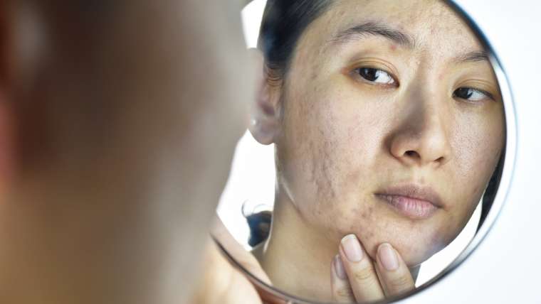 What Can I Do About Acne Scars?