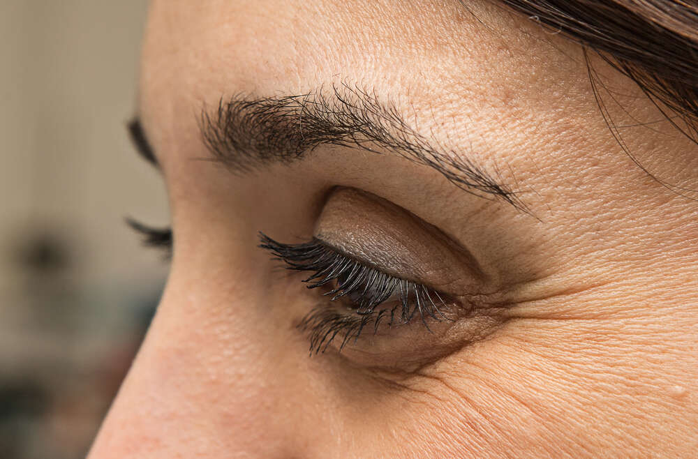 How Long Does Botox Last For Crow’s Feet?