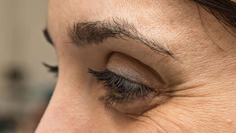 How Long Does Botox Last For Crow’s Feet?