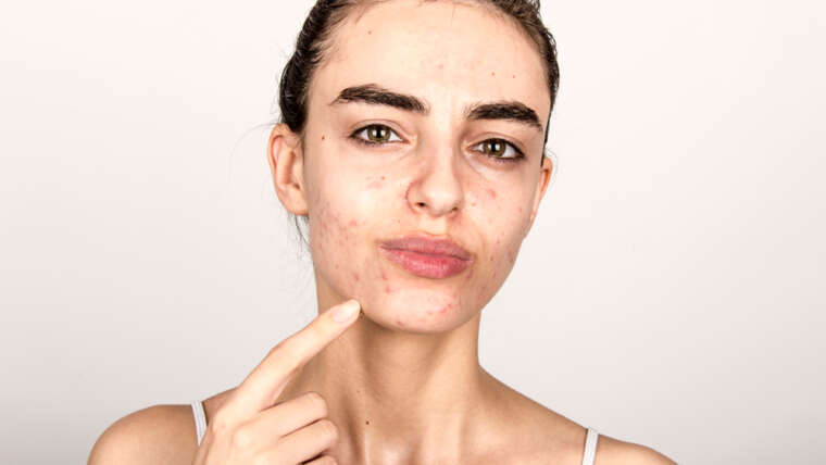 Is Acne Permanent & Can A Specialist Help?