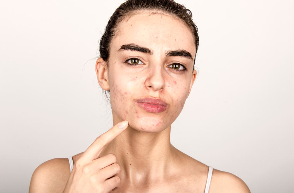 How to Find the Best Acne Doctor in Tysons Corner to Eliminate Breakouts