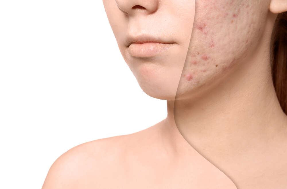 Acne Scar Treatments in Arlington, Virginia