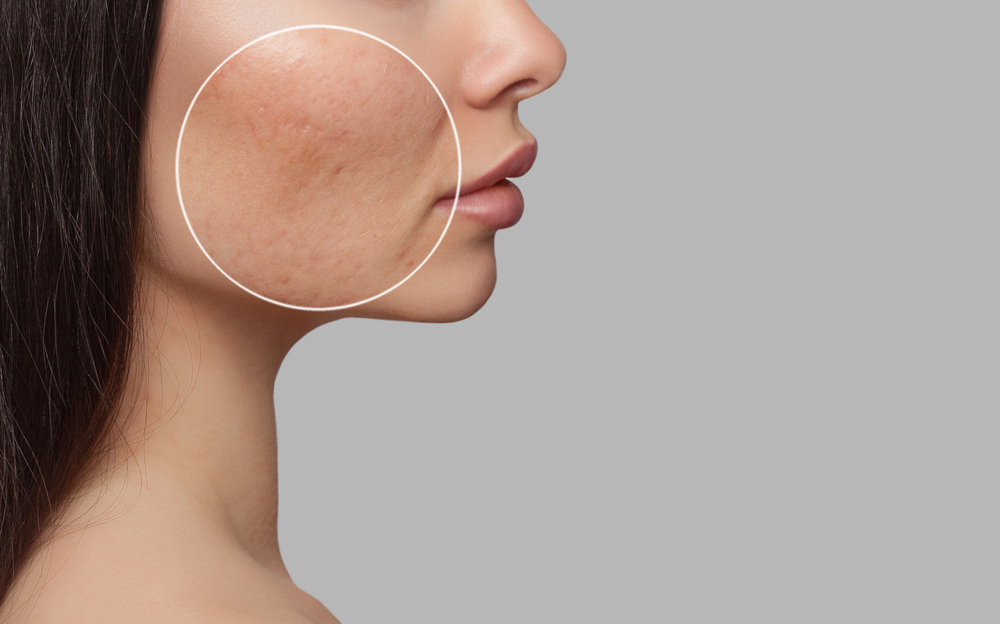 What Are the Best Acne Scar Treatments Near Me for Better Skin?