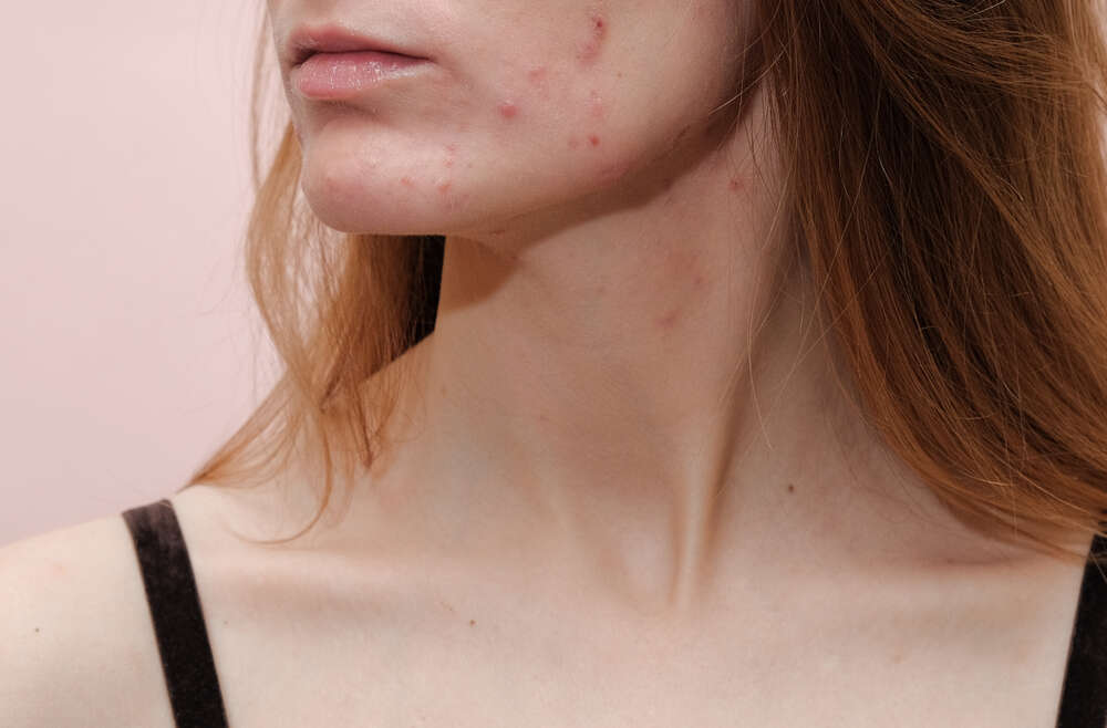 Answers to Your FAQs From an Acne Specialist Near Tysons Corner