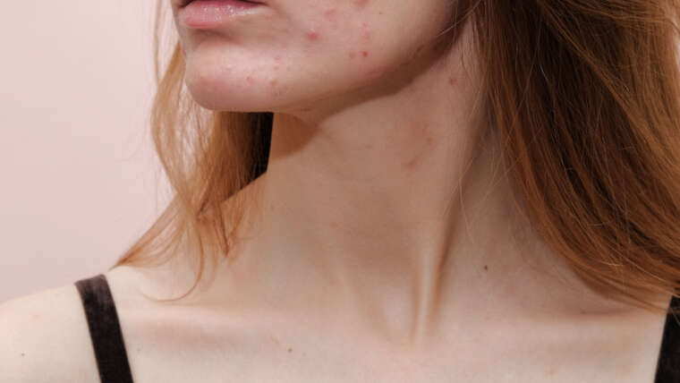 Answers to Your FAQs From an Acne Specialist Near Tysons Corner