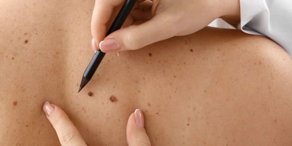 Mole Removal Treatments - Dr Yousefi