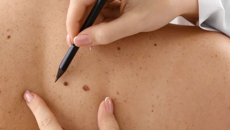 Mole Removal Treatments