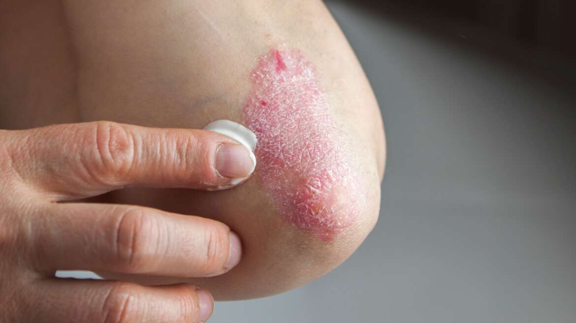 Top Treatments From a Psoriasis Expert