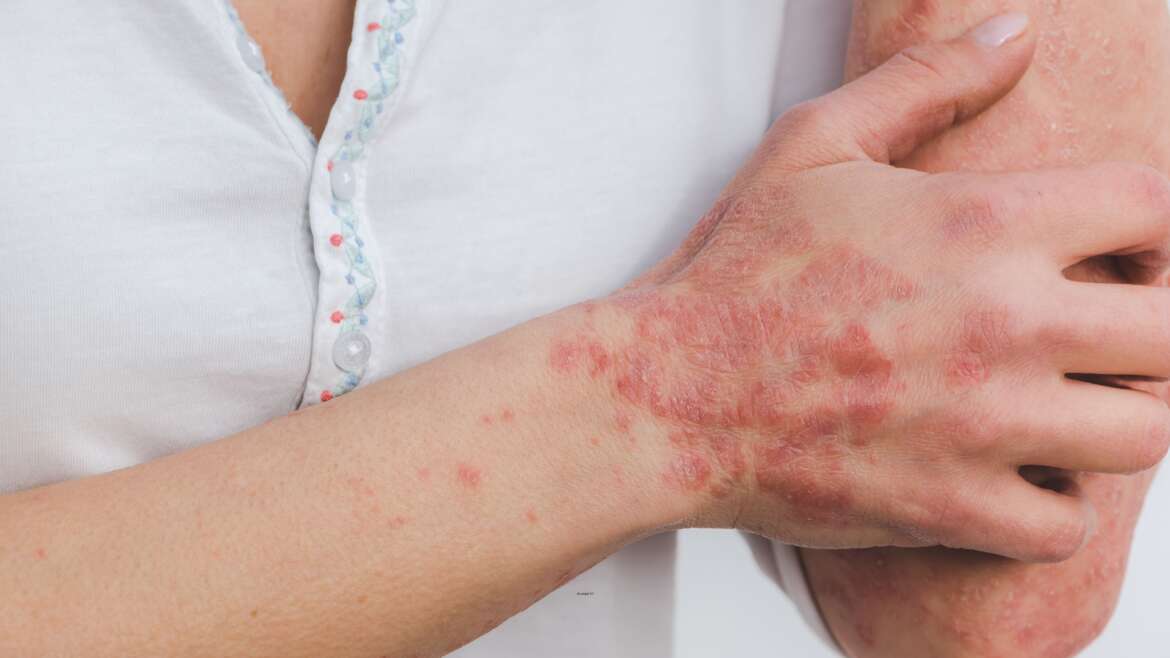 Psoriasis Specialist in Tysons Corner, Virginia