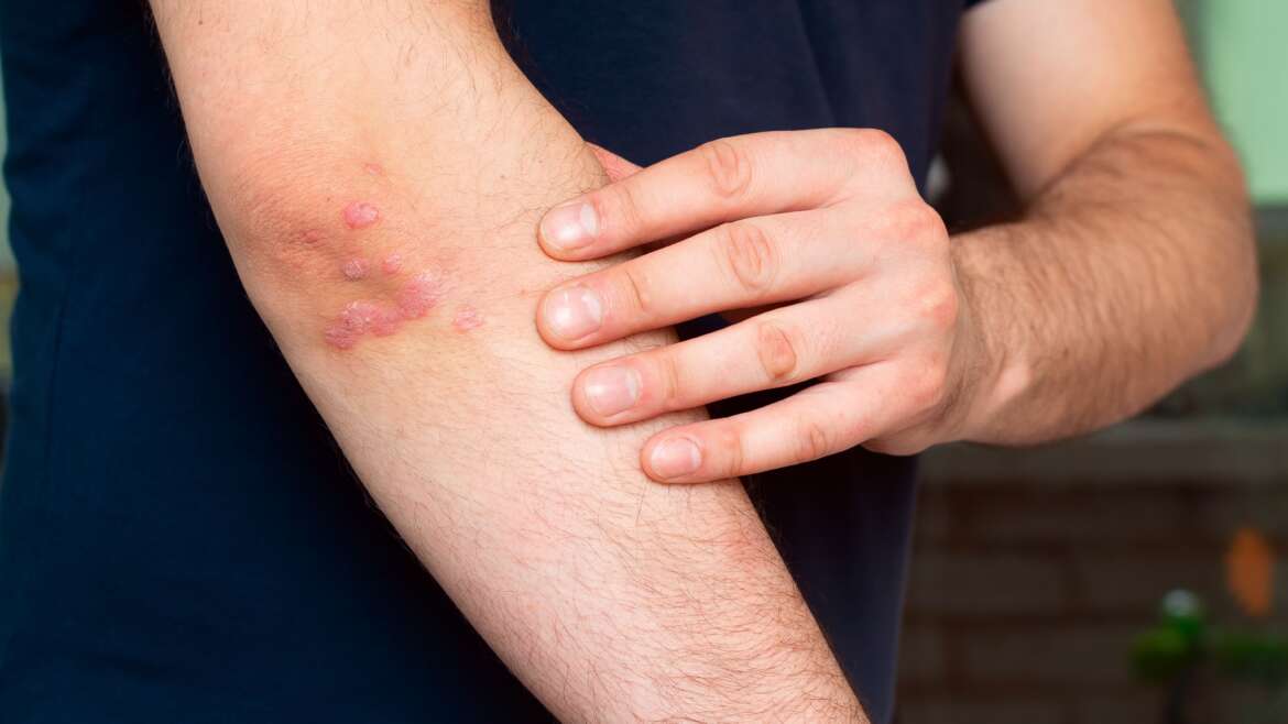 How Long Does Psoriasis Treatment Last?