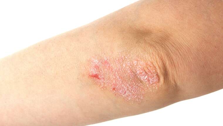 Psoriasis Specialist in Mclean, Virginia