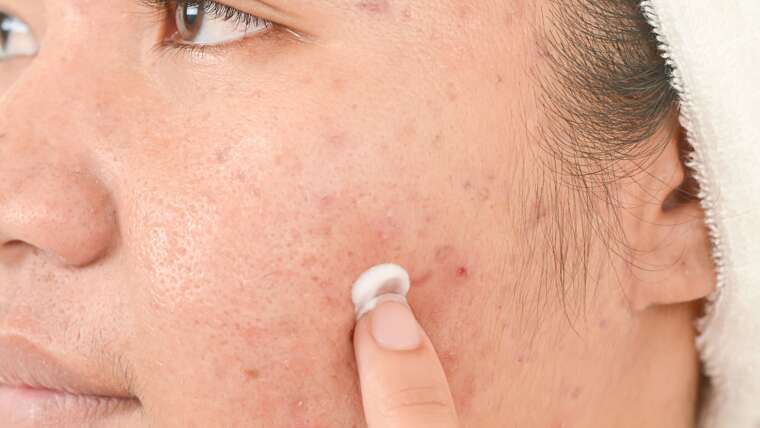 Acne Treatments in Vienna, Virginia