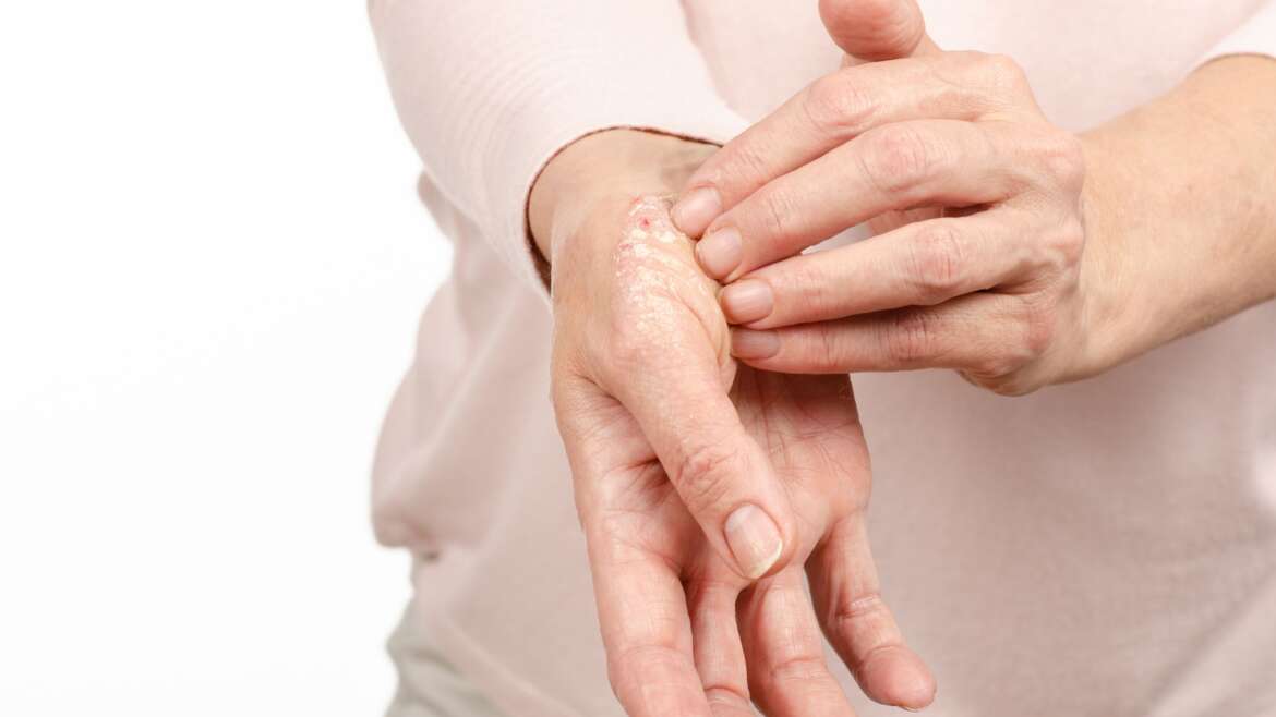 Psoriasis Specialist in Vienna, Virginia