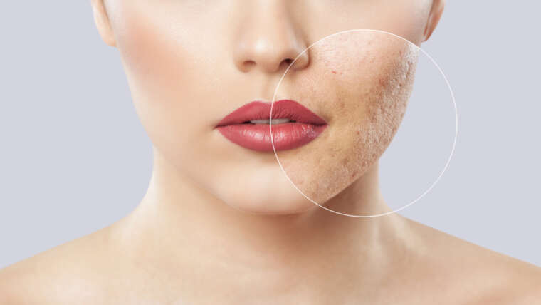 Acne Scar Specialist in Arlington, Virginia