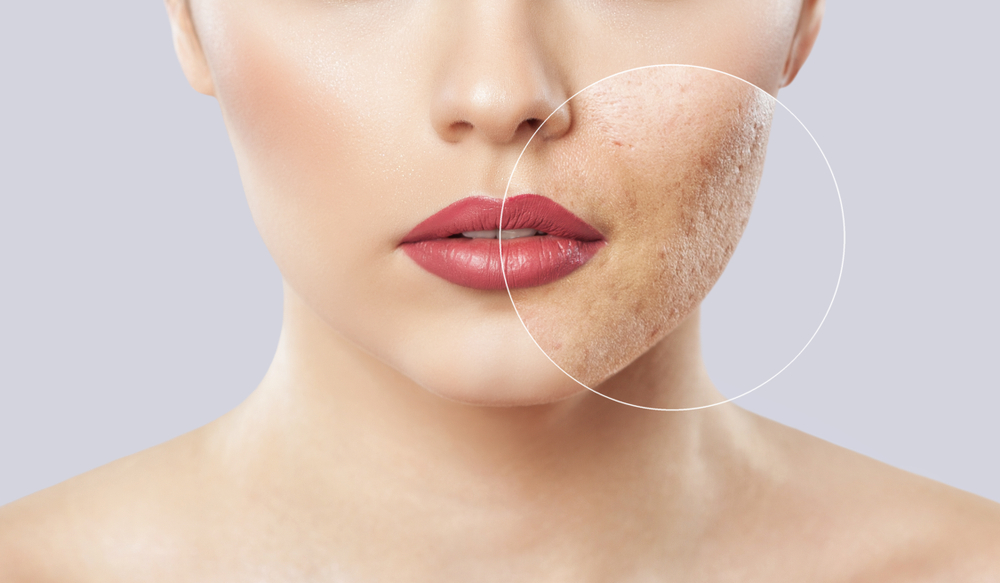 Acne Scar Specialist in Arlington, Virginia