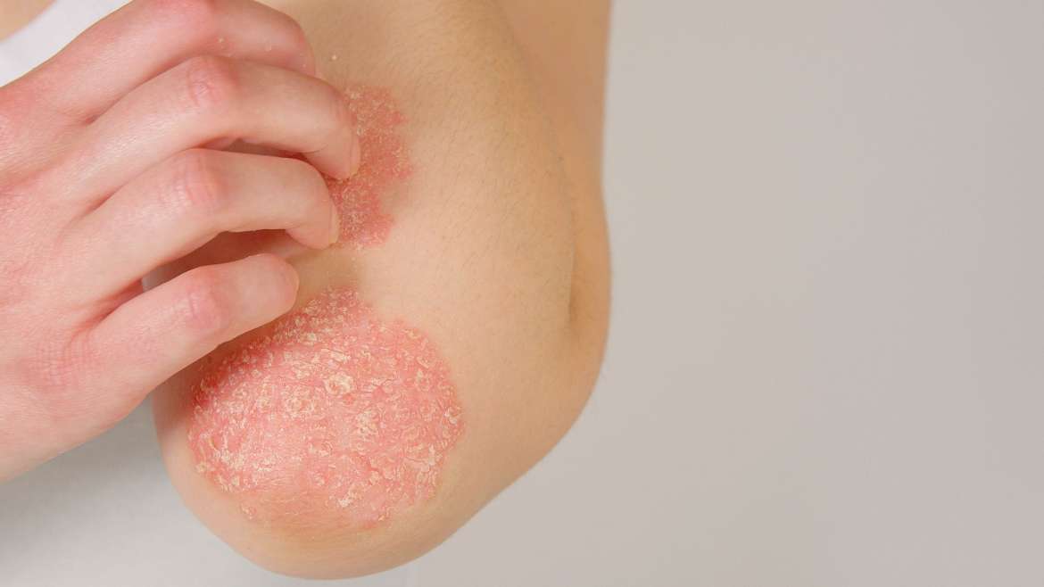 Best Psoriasis Dermatologist in Tysons Corner, Virginia