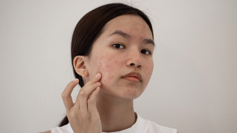 Best Acne Dermatologist in Falls Church, Virginia