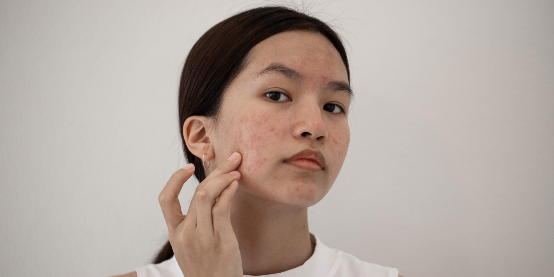 Best Acne Dermatologist in Falls Church, Virginia Dr Yousefi