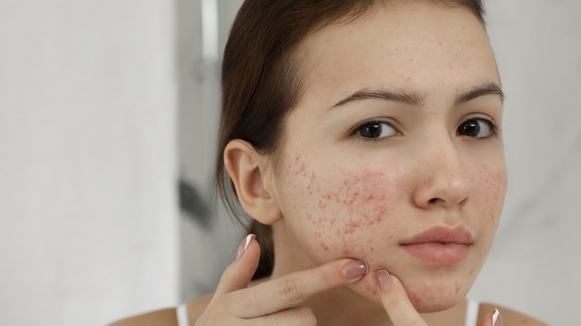 Can I Do Botox If I Have Acne?