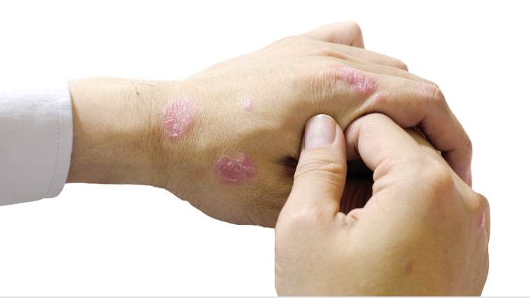 Can Stopping Alcohol Consumption Help With Psoriasis