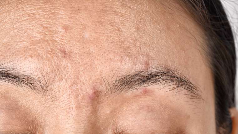 Best Acne Scar Treatment in Arlington, Virginia