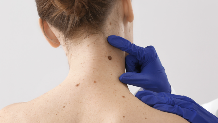 How to Find a Skin Cancer Doctor in Vienna, VA