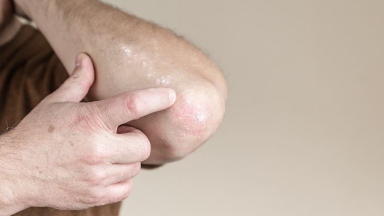 Top Psoriasis Specialist in Falls Church, Virginia