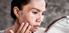 Dark Spot Removal Treatment in Arlington and Vienna, Virginia