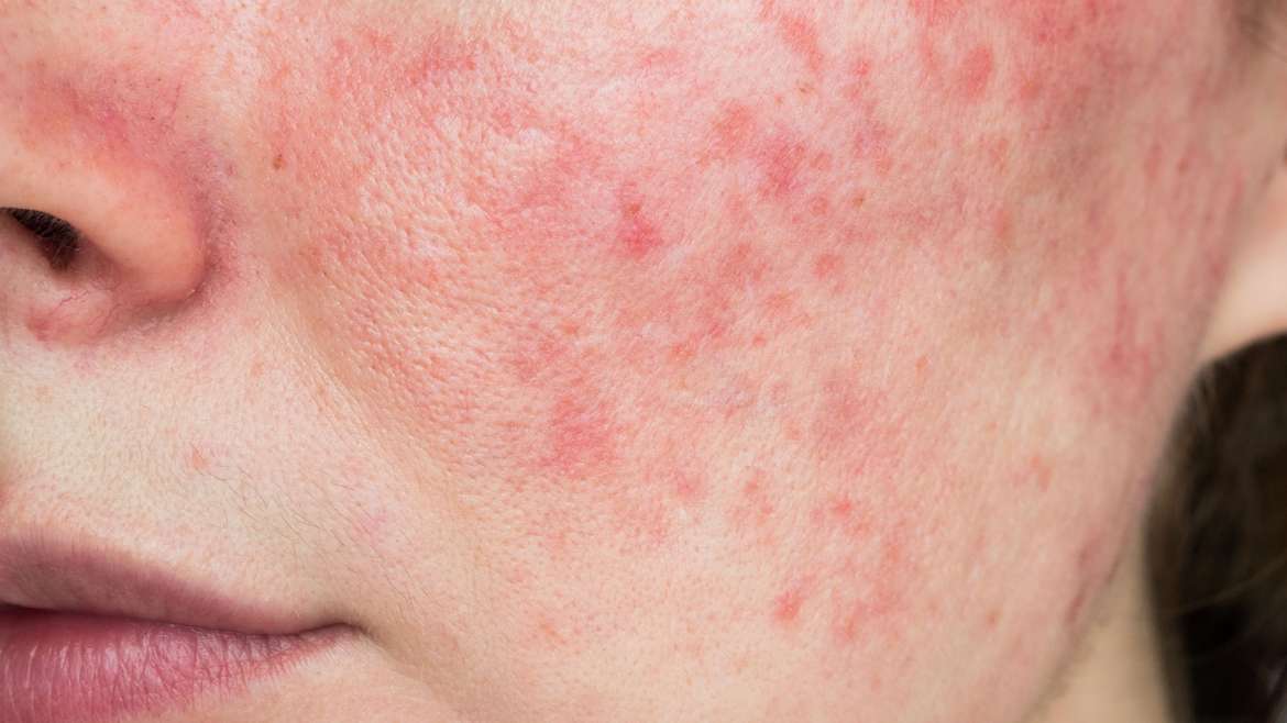 Best Rosacea Doctor In Arlington, Virginia