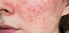 Best Rosacea Doctor In Arlington, Virginia