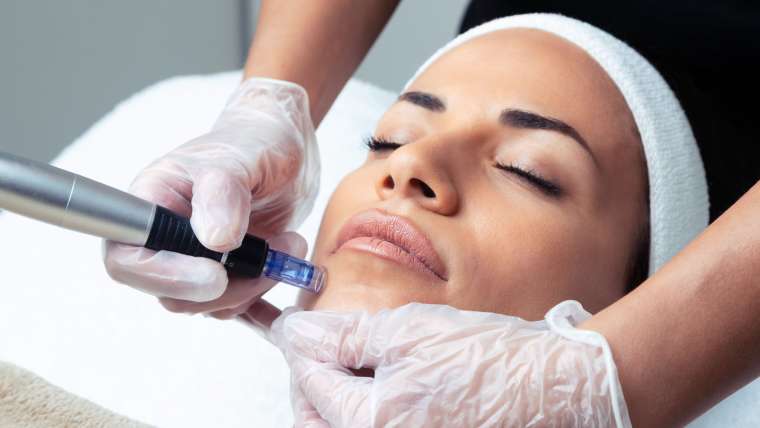 Best Microneedling Results in Arlington, Virginia