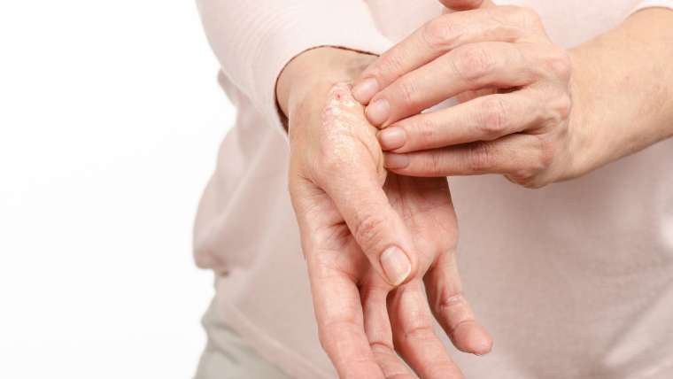 Psoriasis Consultation and Prescription in Falls Church