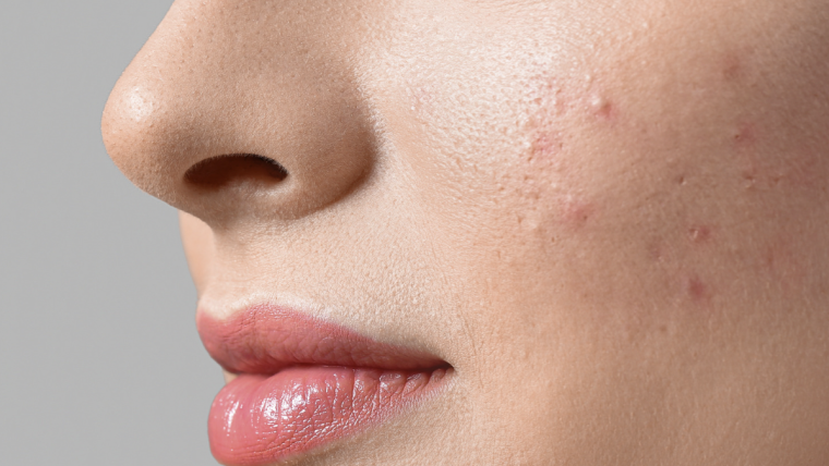 Get Acne Help in Arlington with a Top Dermatologist