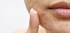 Safest Acne Treatment in Alexandria