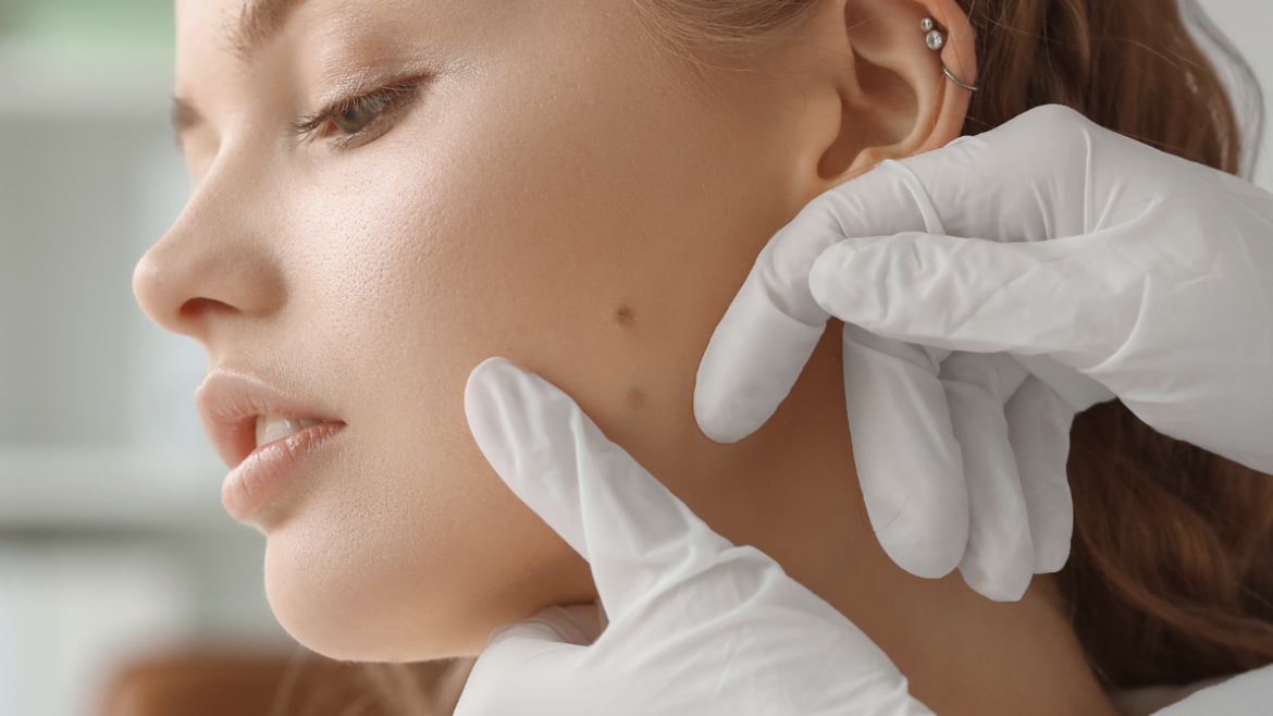 Dark Spot Removal Treatment in Arlington