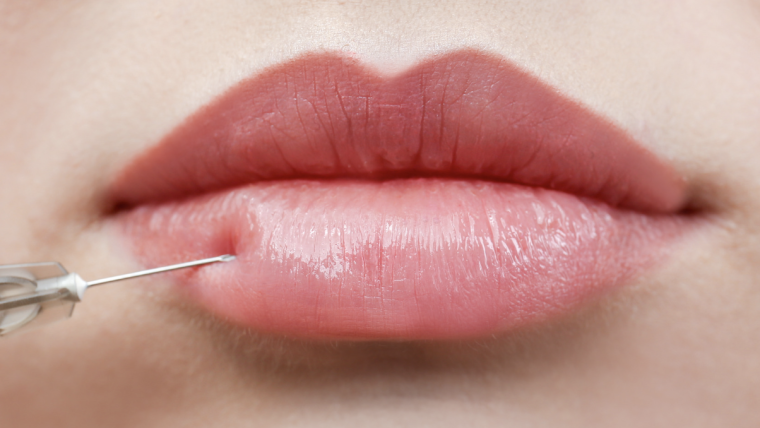 Longest-Lasting Lip Filler