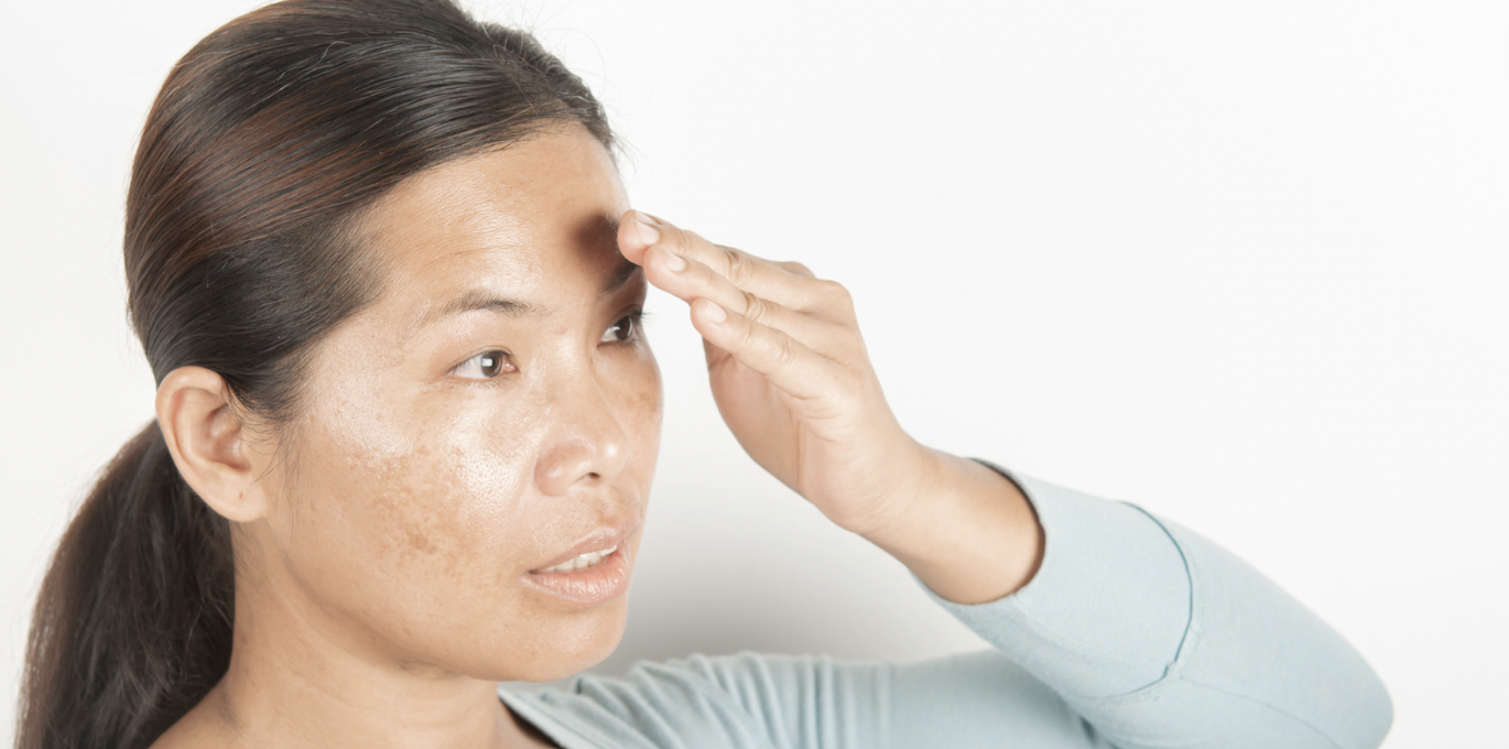 How to Remove Dark Spots Permanently Dr Yousefi