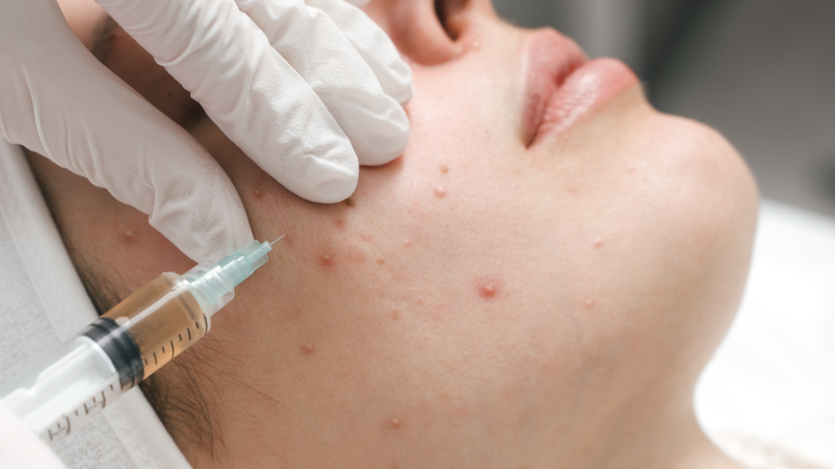 Acne Treatment in Arlington