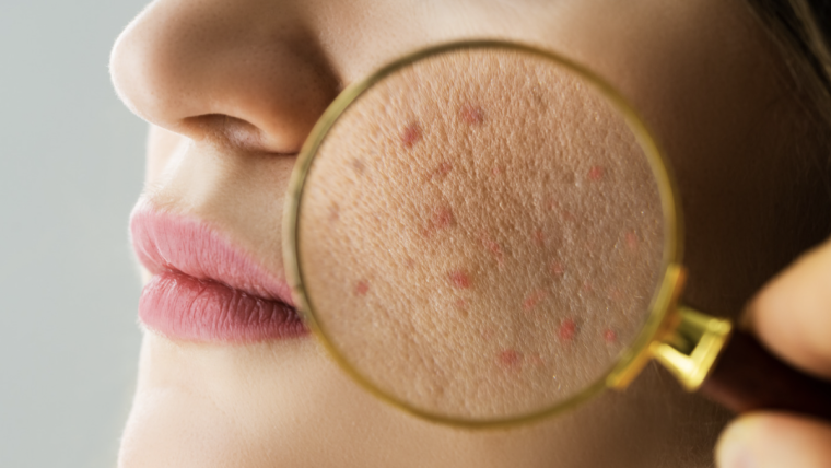 How to Find the #1 Acne Specialist in Arlington