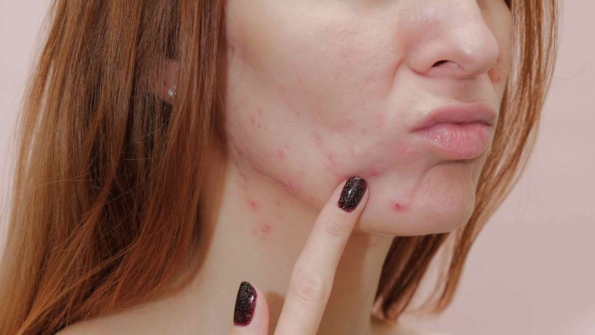 Same-Day Acne Treatment in Arlington