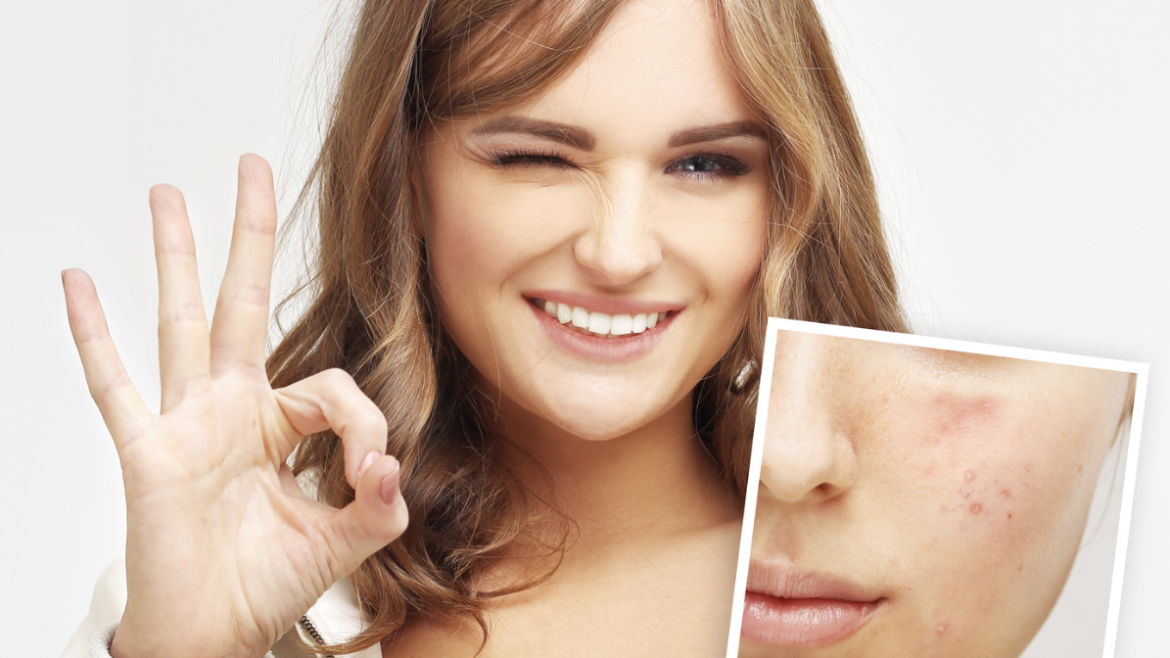 Best Acne Specialist in Arlington