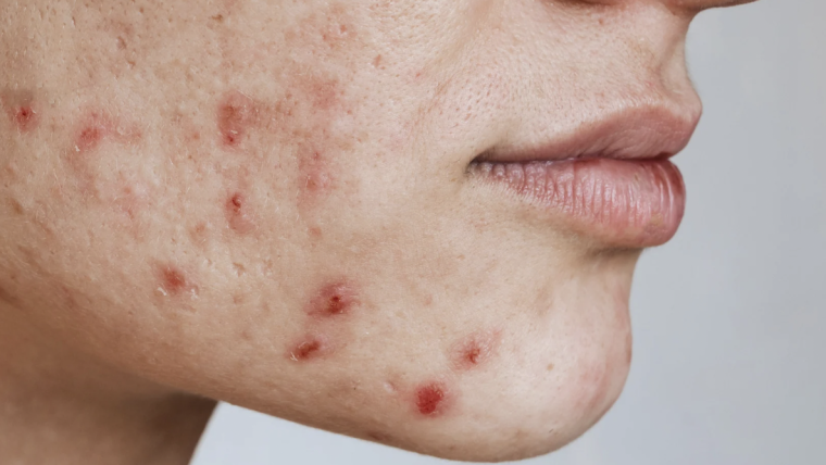 Top Acne Dermatologist