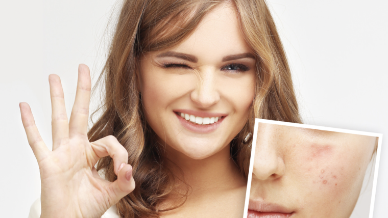 Acne Scar Specialist in Arlington
