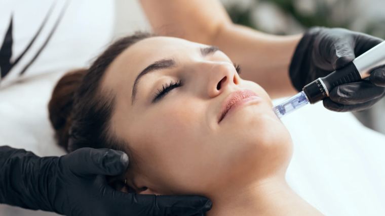 Is Microneedling for Acne Scars Permanent?