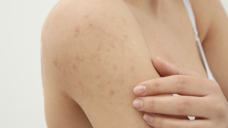 Psoriasis Specialist in Vienna, Virginia